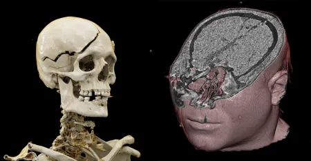 Deze man kreeg een kogel door het hoofd, afkomstig van een zwaar kaliber handvuurwapen. Op de CT-scan zijn de in- en uitgangswonde door het hoofd zichtbaar. Er bevinden zich geen kogel of kogelsporen meer in het hoofd van het slachtoffer.